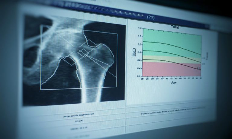 Densitometría Ósea
