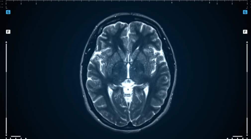 resonancia magnética y por qué es tan útil en neurología