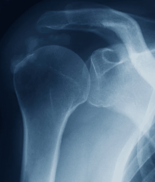 Tendinitis en el hombro: causas, síntomas y cómo evitar que se vuelva crónica