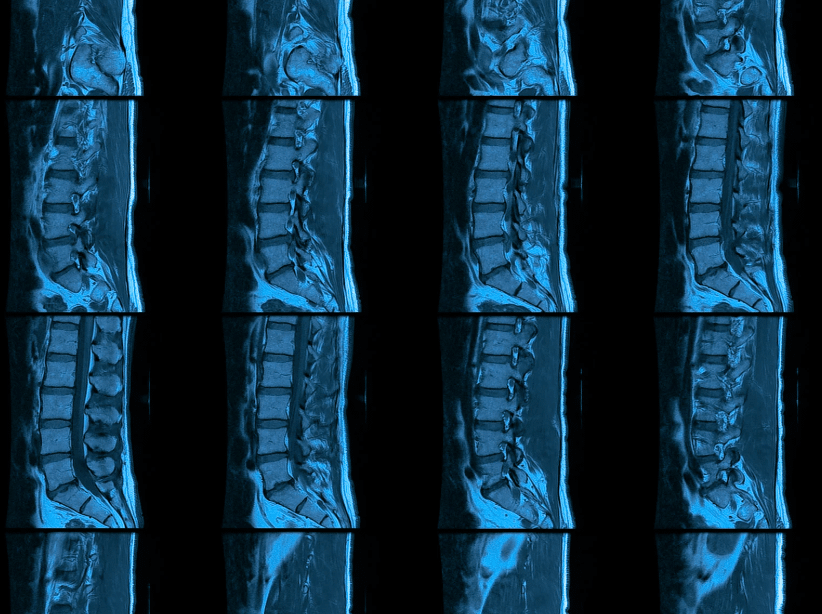 ¿Qué muestra una resonancia de columna y cuándo está indicada?